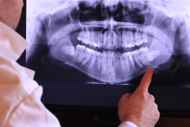 Best Emergency Tooth Extraction in Gholson, TX