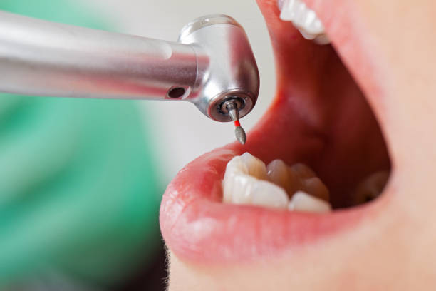 Best Emergency Treatment for Dental Infections or Abscesses in Gholson, TX